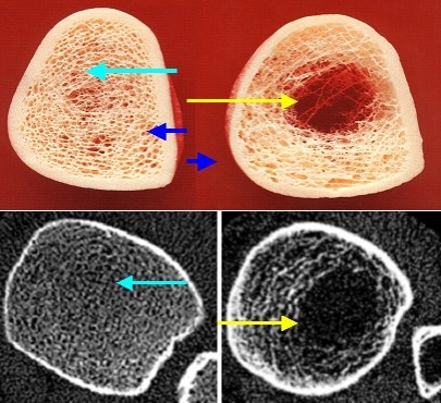 mit weltraumtechnik der osteoporose auf der spur