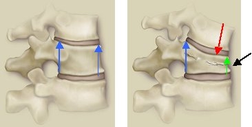 Osteoporose, Osteoporosezentrum München, Dr. med. Radspieler, Folgen, Wirbeleinbruch