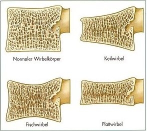 Osteoporose, Osteoporosezentrum München, Dr. med. Radspieler, Folgen, Typische Wirbelkörperbrüche