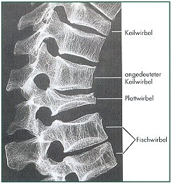 Osteoporose, Osteoporosezentrum München, Dr. med. Radspieler, Folgen, Typische Wirbelkörperbrüche