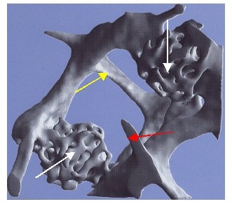 Osteoporose, Osteoporosezentrum München, Dr. med. Radspieler, Knochendichtemessung, Knochendichte, Diagnostik, Mokrokallusbildung