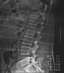 Osteoporose, Osteoporosezentrum München, Dr. med. Radspieler, Knochendichtemessung, Knochendichte, Diagnostik, Computertomographie