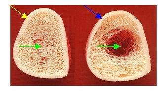 Osteoporose, Osteoporosezentrum München, Dr. med. Radspieler, Knochendichtemessung, Knochendichte, Diagnostik, 3-dimensionale Bälkchenstruktur des Knochens, Struktur der Knochen, Knochenvergleich