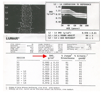 Osteoporose, Osteoporosezentrum München, Dr. med. Radspieler, Knochendichtemessung, Knochendichte, Ultraschall, DXA