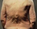 Osteoporose, Osteoporosezentrum München, Dr. med. Radspieler, Symptome, Tannenbaumphänomen Osteoporose, Osteoporosezentrum München, Dr. med. Radspieler, Symptome, Tannenbaumphänomen