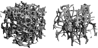 Osteoporose, Osteoporosezentrum München, Dr. med. Radspieler, Ursachen, Zerstörte Mikroarchitektur