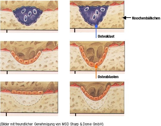 Osteoporose, Osteoporosezentrum, Dr. med. Radspieler, Ursachen, Remodeling