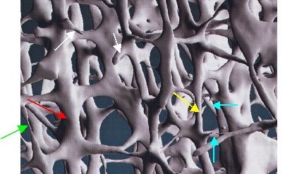 Osteoporosezentrum München, Dr. Radspieler, Knochendichtemessung, Knochendichte, Diagnostik, 3-dimensionale Bälkchenstruktur des Knochens, Struktur der Knochen