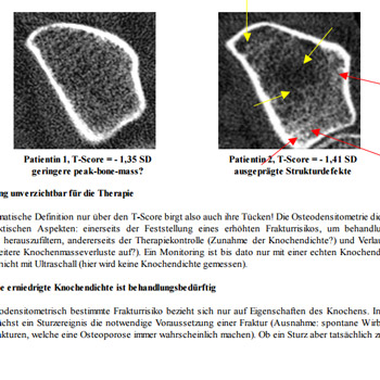 Diagnostik und Therapie der Osteoporose