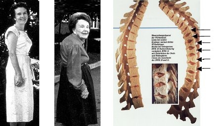 Osteoporose-Folgen: Bilder von Witwenbuckel im Vergleich zu einem normalen Rücken